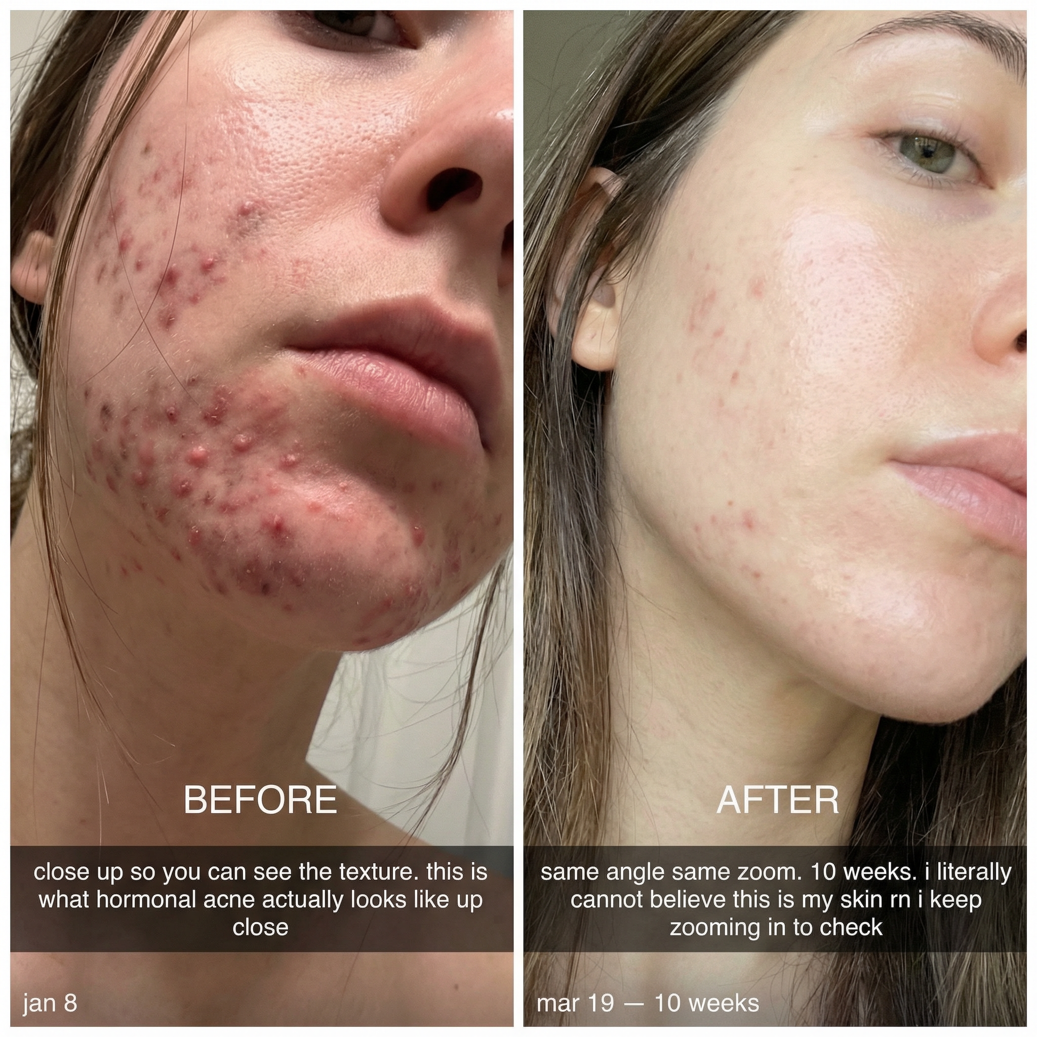 THE CLEAR FORTRESS™ - 3-Phase Acne Defense System