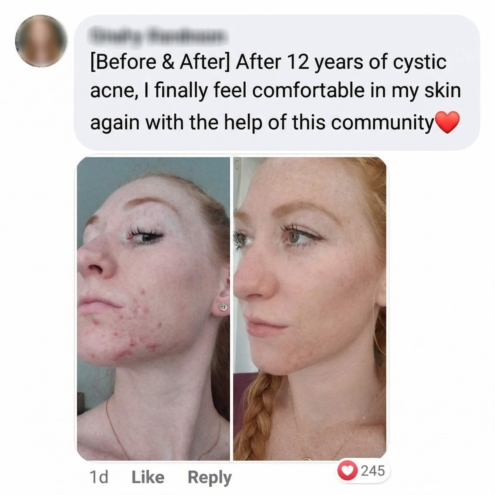 THE CLEAR FORTRESS™ - 3-Phase Acne Defense System