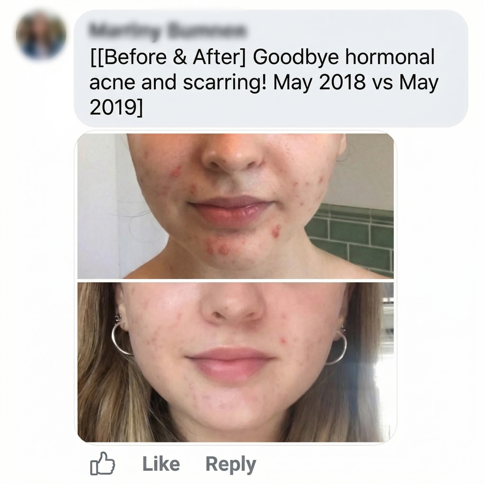 THE CLEAR FORTRESS™ - 3-Phase Acne Defense System