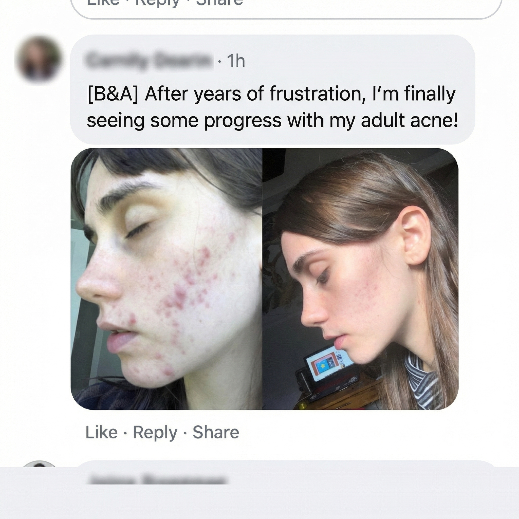 THE CLEAR FORTRESS™ - 3-Phase Acne Defense System