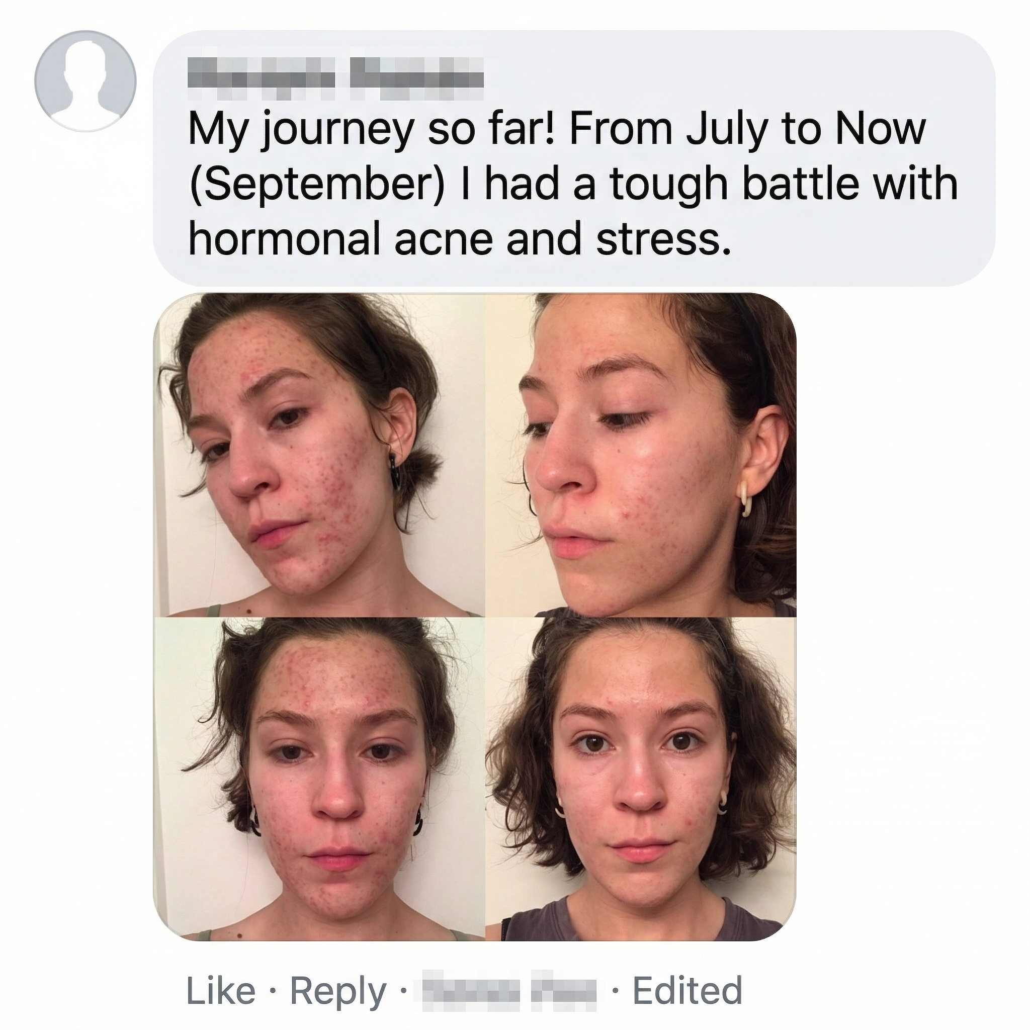 THE CLEAR FORTRESS™ - 3-Phase Acne Defense System