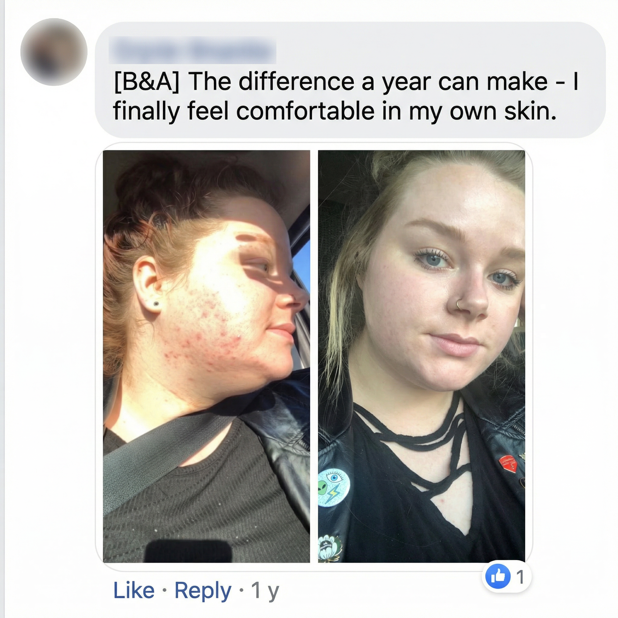 THE CLEAR FORTRESS™ - 3-Phase Acne Defense System