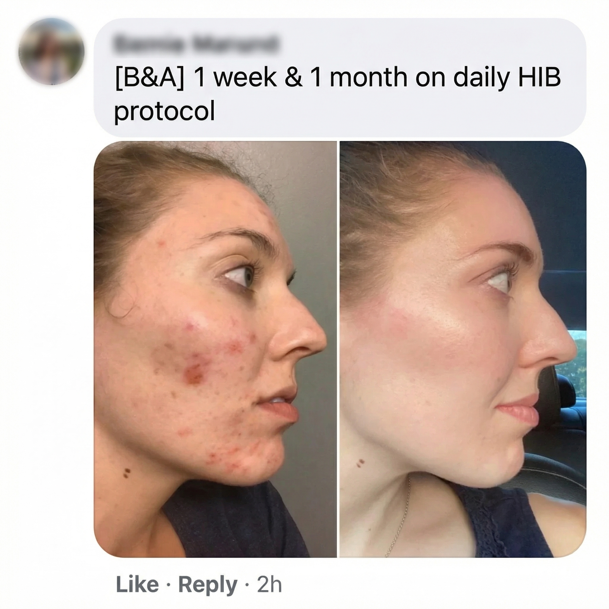 THE CLEAR FORTRESS™ - 3-Phase Acne Defense System