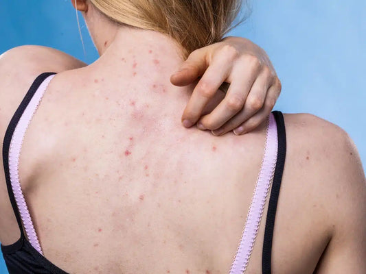 Beyond Acne: The Truth